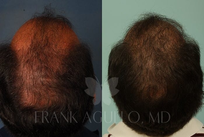 Hair Transplant Before and After 2