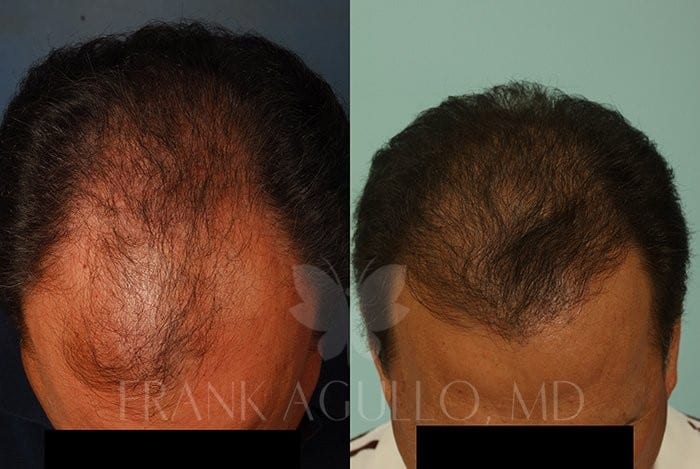 Hair Transplant Before and After 3