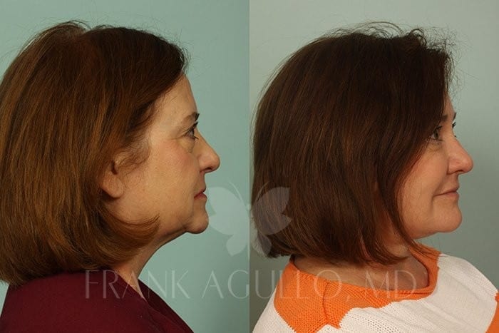 Hair Transplant Before and After 2