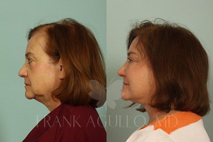 Hair Transplant Before and After 8