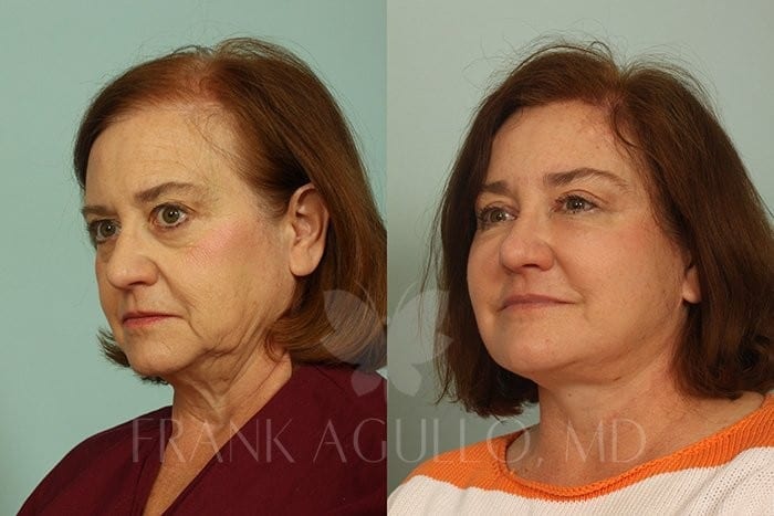 Hair Transplant Before and After 7