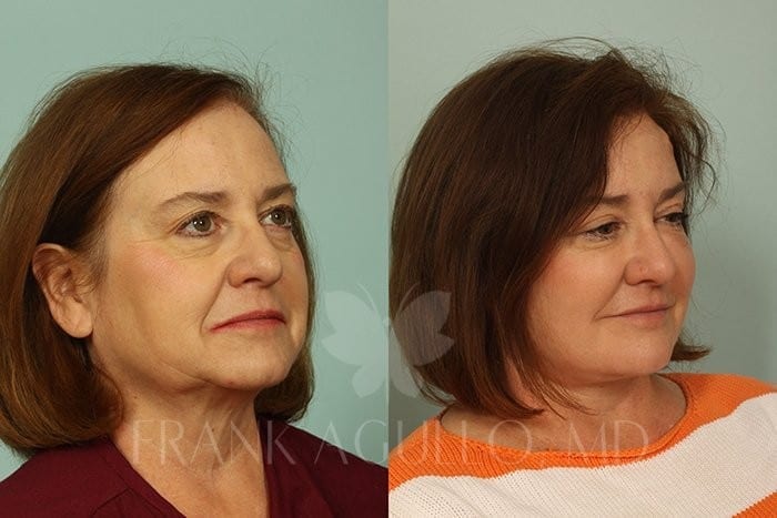 Hair Transplant Before and After 6