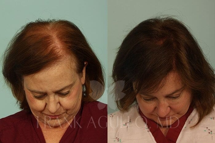 Hair Transplant Before and After 5