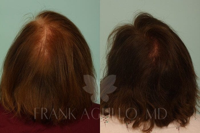 Hair Transplant Before and After 4