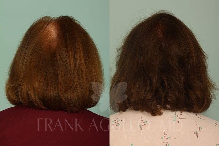 Hair Transplant Before and After 3