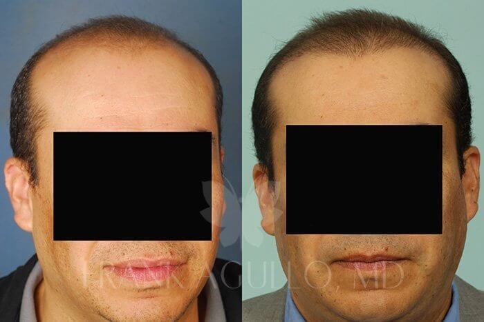 Hair Transplant Before and After 10