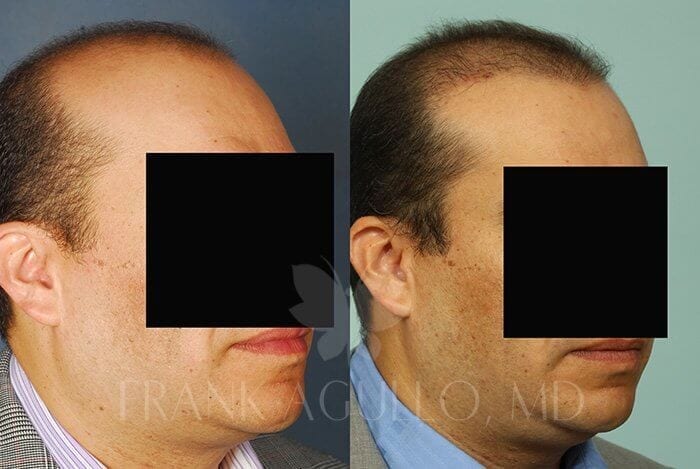 Hair Transplant Before and After 2