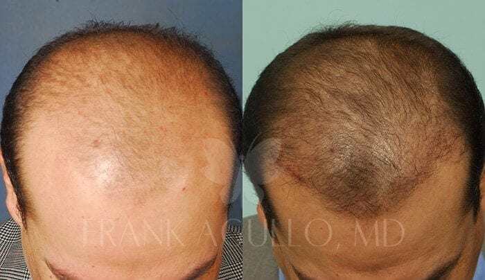 Hair Transplant Before and After 3