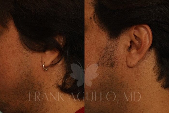 Hair Transplant Before and After 9