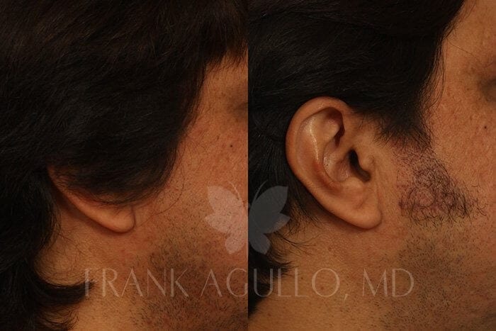 Hair Transplant Before and After 2