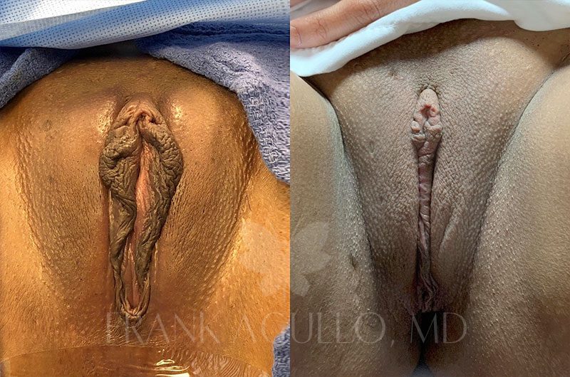 Labiaplasty Before and After 16