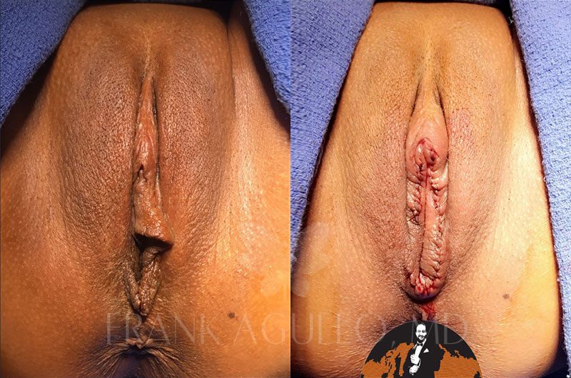 Labiaplasty Before and After 14