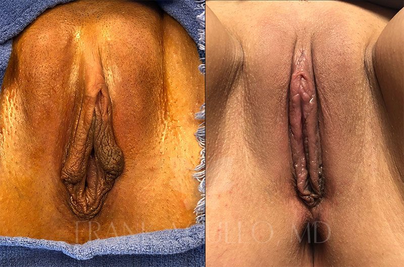 Labiaplasty Before and After 5