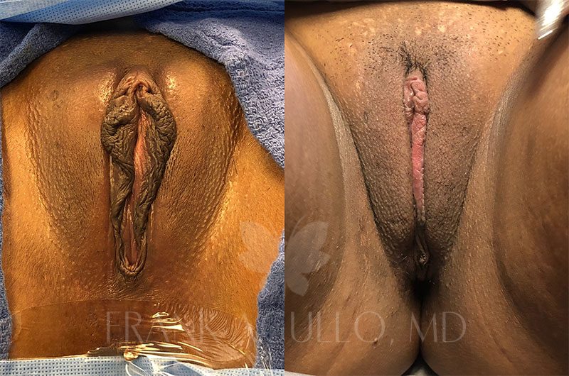 Labiaplasty Gallery.