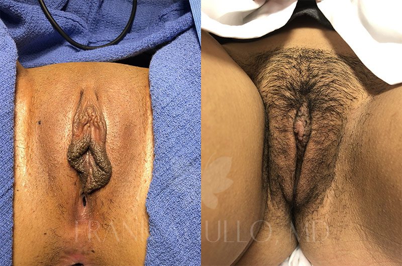 Labiaplasty Before and After 2