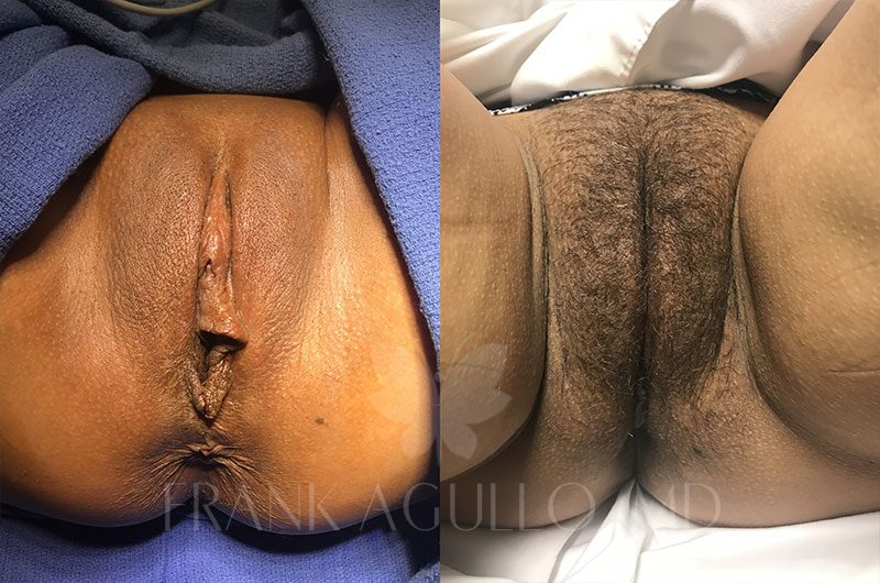 Labiaplasty Before and After 1