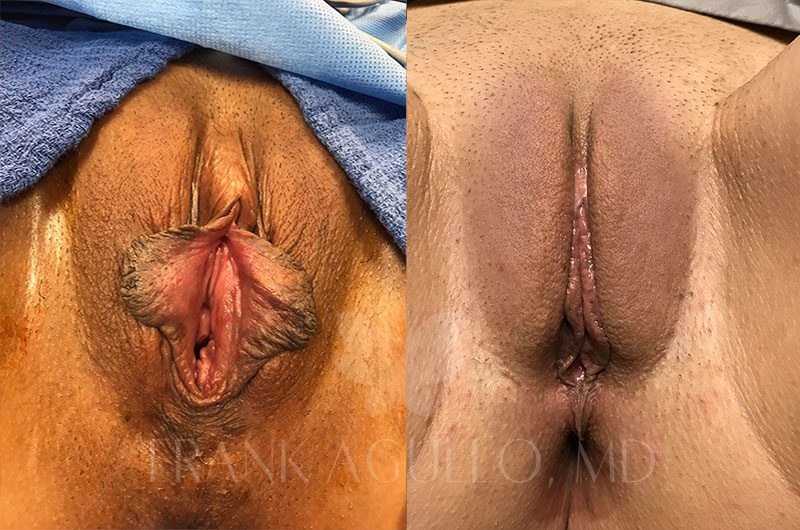 Labiaplasty Before and After 20