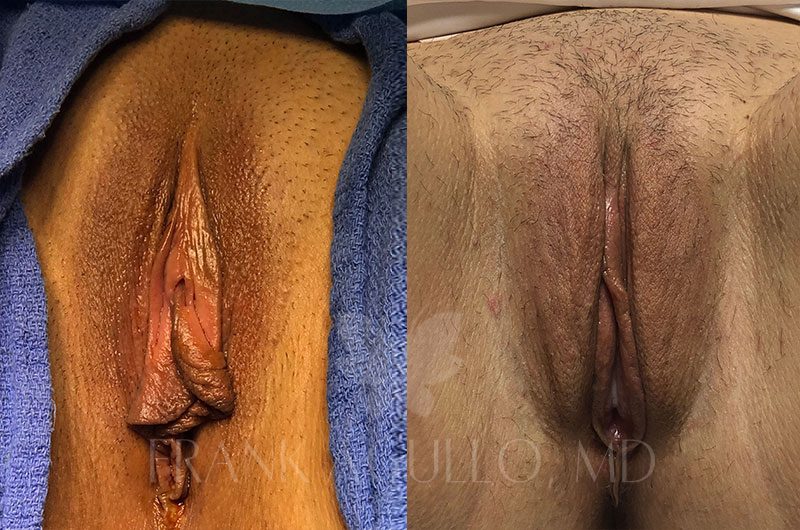 Labiaplasty Before and After 19