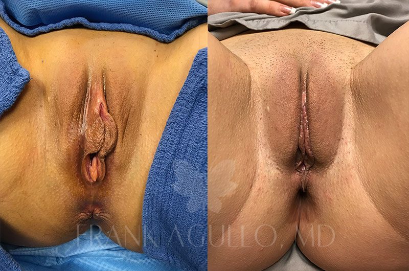 Labiaplasty Before and After 18