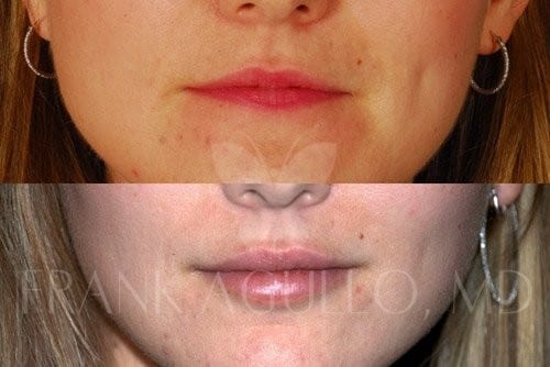 Lip Augmentation Before and After 2