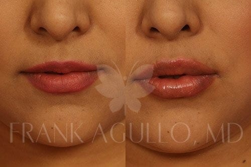 Lip Augmentation Before and After 1