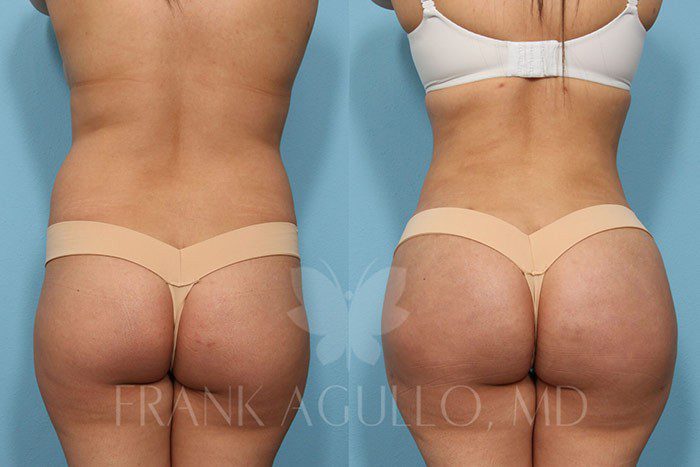 Brazilian Butt Lift Before and After 10