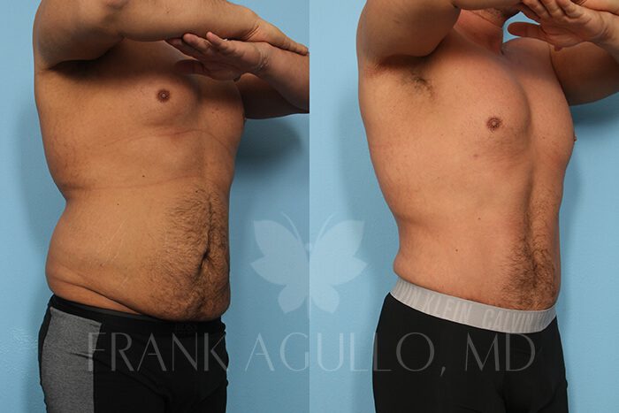 Liposuction Before and After 2