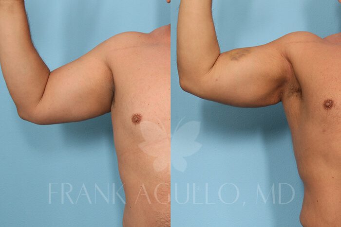 Liposuction Before and After 3