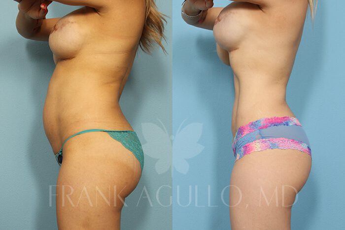 Liposuction Before and After 2