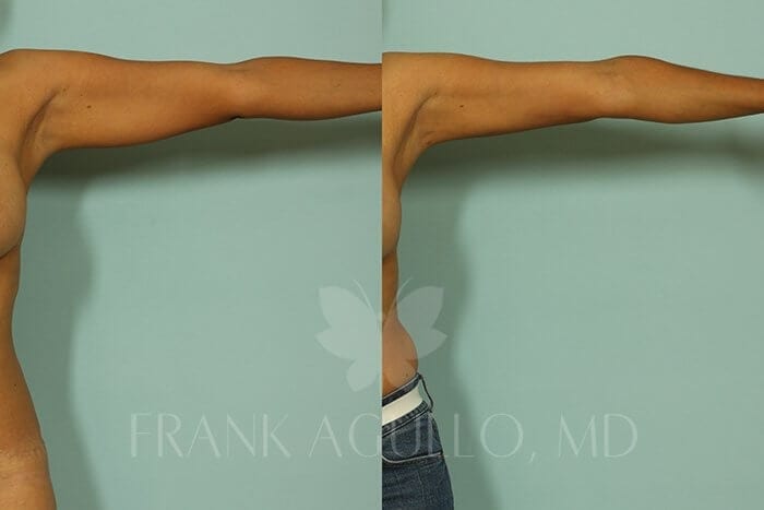 Liposuction Before and After 4