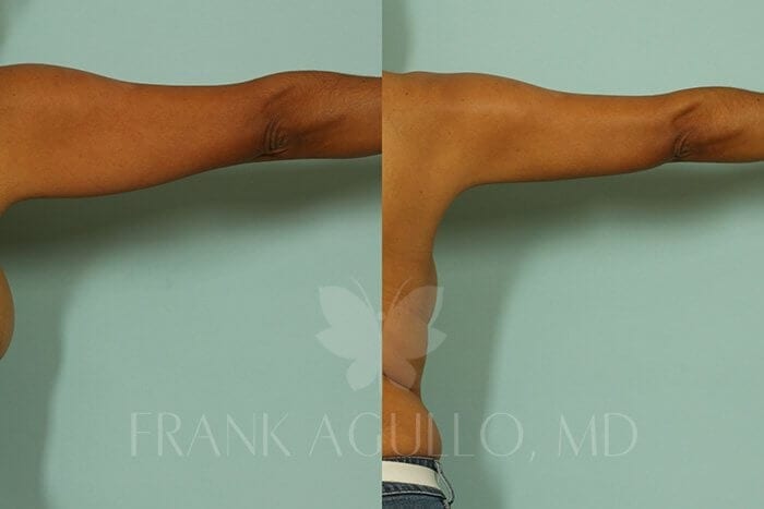 Liposuction Before and After 15