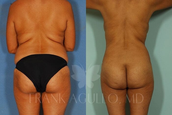 Liposuction Before and After 14