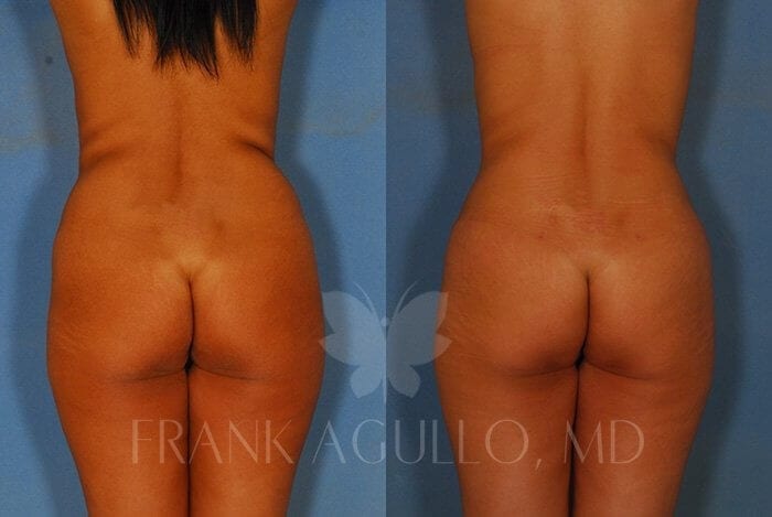 Liposuction Before and After 5
