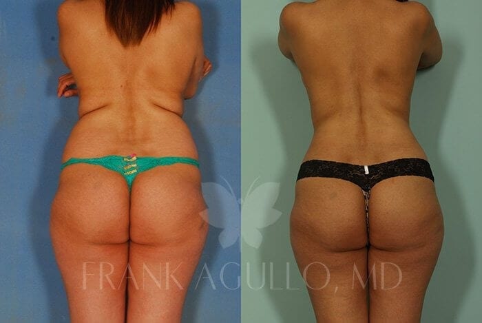 Liposuction Before and After 5