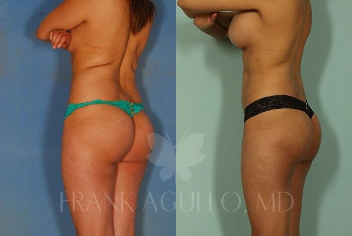 Liposuction Before and After 3