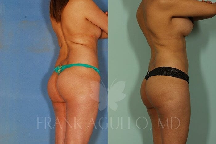 Liposuction Before and After 2