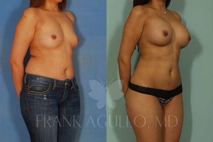 Liposuction Before and After 4