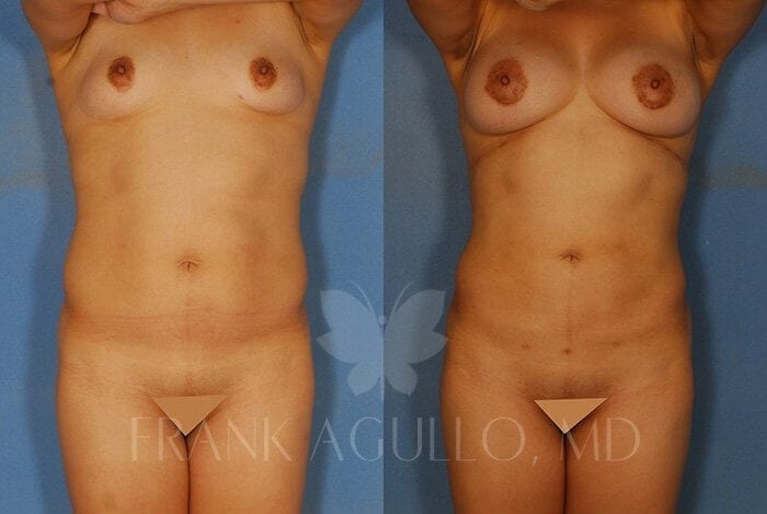 Liposuction Before and After 3