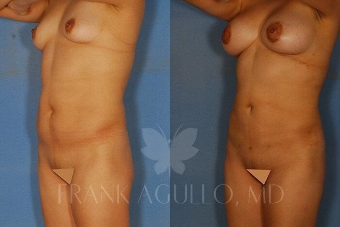 Liposuction Before and After 2