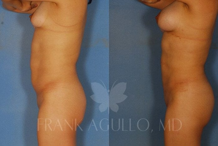 Liposuction Before and After 3