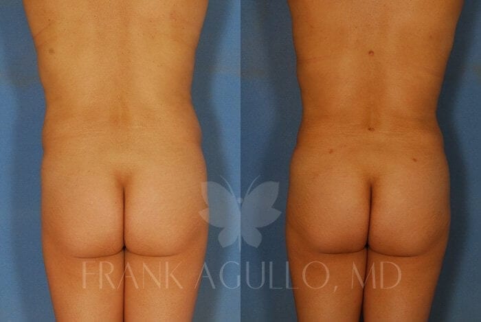 Liposuction Before and After 5