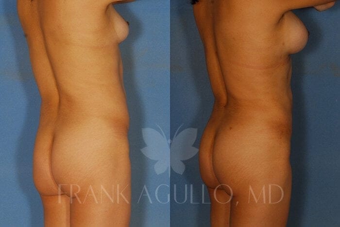 Liposuction Before and After 6