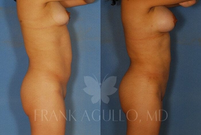 Liposuction Before and After 7