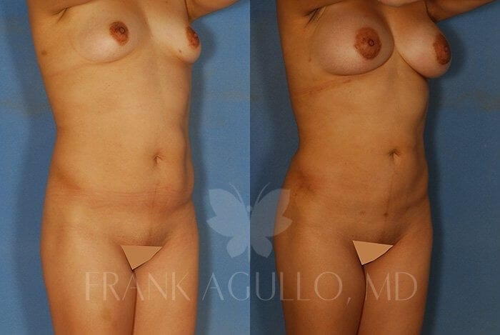 Liposuction Before and After 8