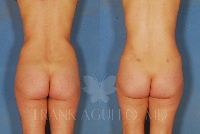 Liposuction Before and After 9