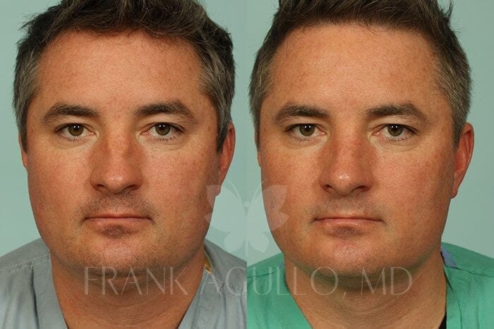 Liposuction Before and After 13