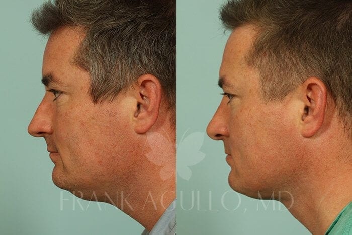 Liposuction Before and After 4