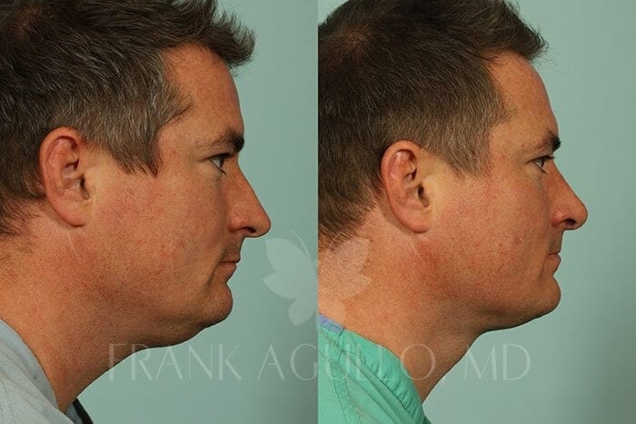 Liposuction Before and After 3