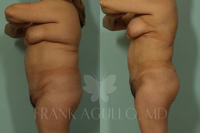 Liposuction Before and After 2