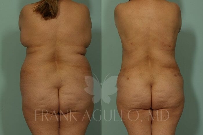 Liposuction Before and After 3